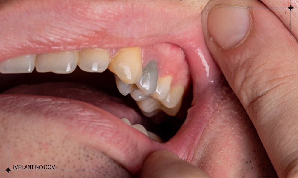 عکس تغییر رنگ دندان بعد از عصب کشی