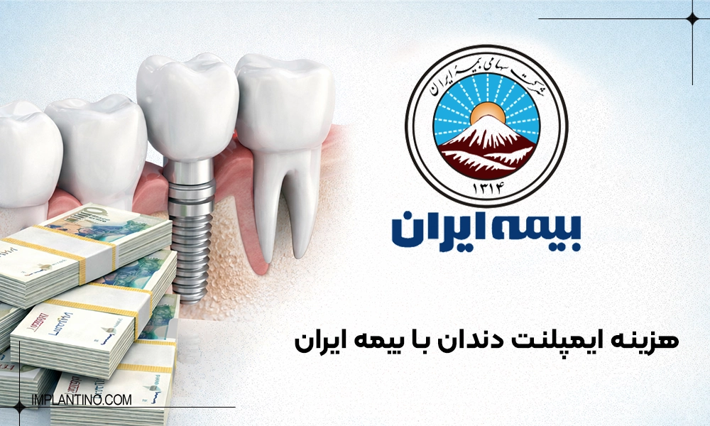 هزینه ایمپلنت دندان با بیمه ایران