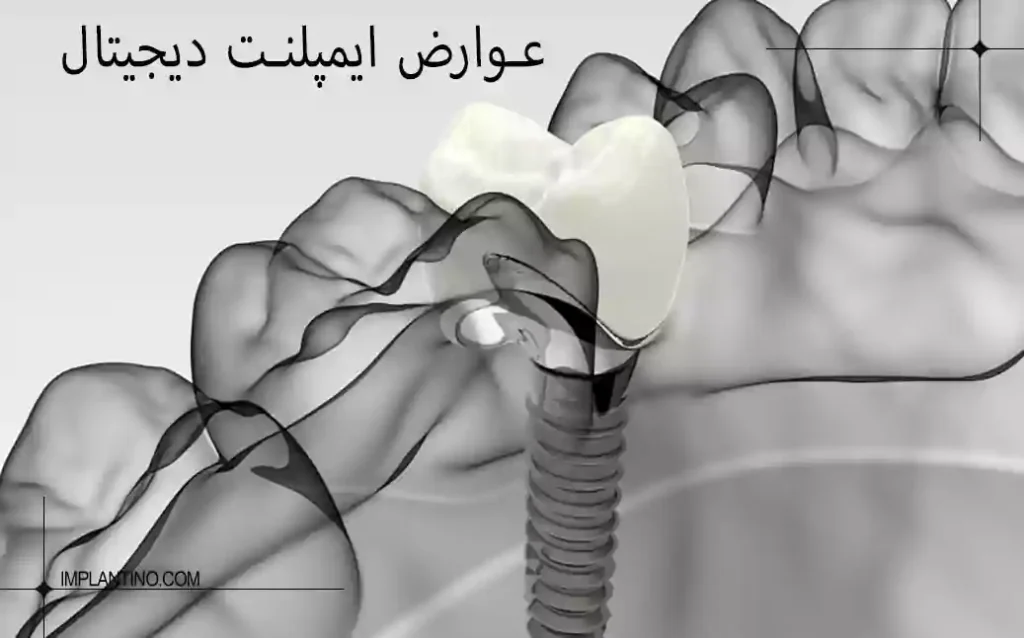 عوارض ایمپلنت دیجیتال