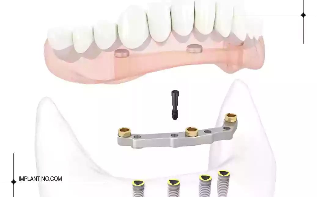 عوارض ایمپلنت دیجیتال 2 عوارض ایمپلنت دیجیتال در فک بالا و فک پایین
