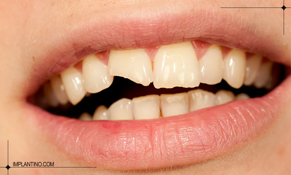 شکستگی دندان و انواع آن 1 د2