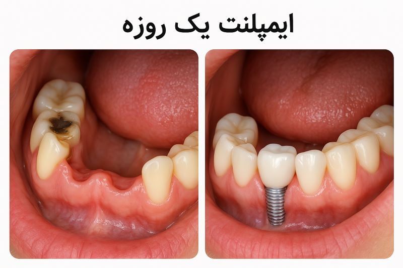 ایمپلنت یک روزه 1 یک روزه