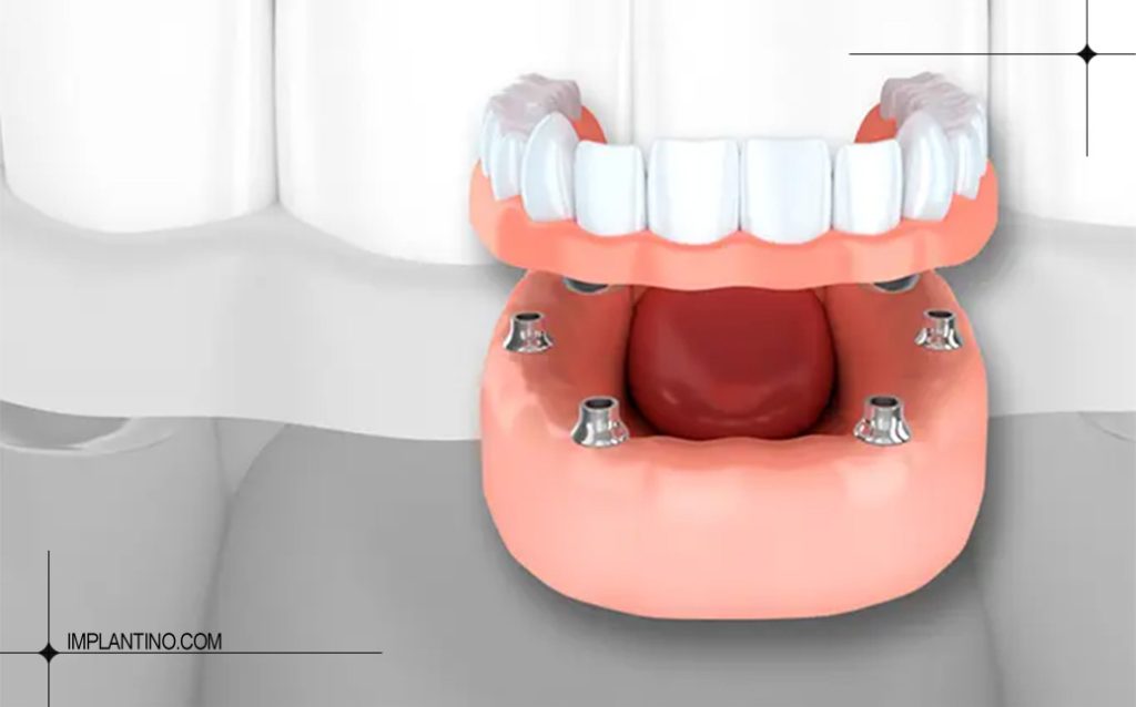 ایمپلنت دیجیتال چیست؟ مزایا، معایب و تفاوت با روش معمولی 1 ایمپلنت دیجیتال چیست 0