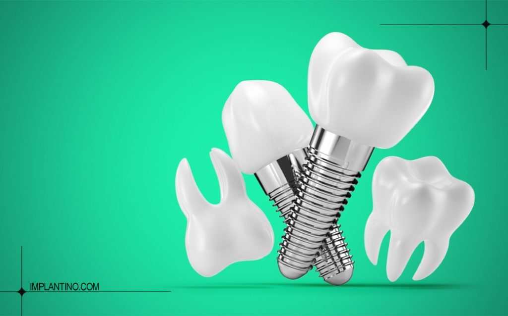 ایمپلنت دیجیتال چیست؟ مزایا، معایب و تفاوت با روش معمولی 2 ایمپلنت دیجیتال چیست 2