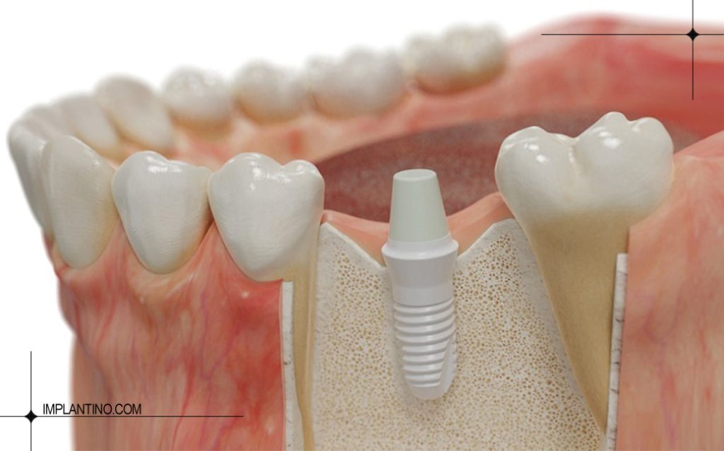 ایمپلنت دیجیتال چیست؟ مزایا، معایب و تفاوت با روش معمولی 4 ایمپلنت دیجیتال چیست 4