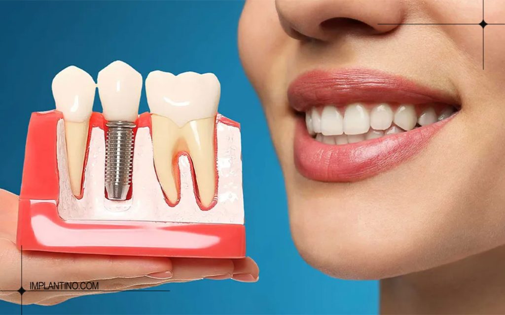 هزینه ایمپلنت دیجیتال 1