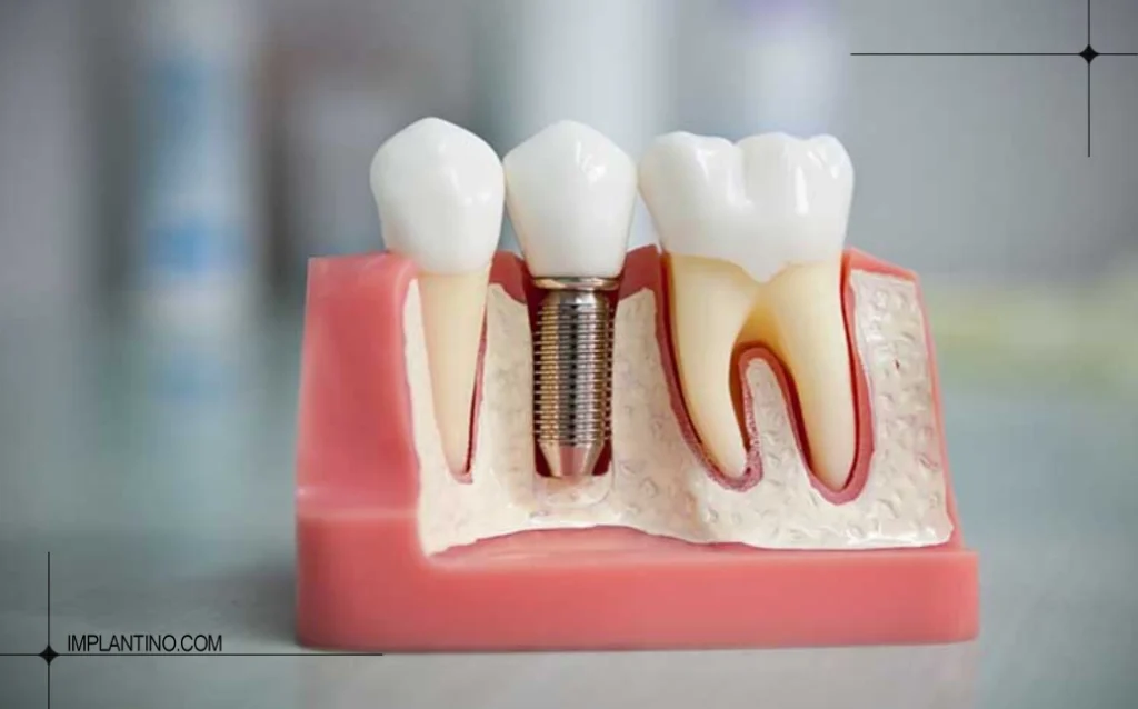 تفاوت ایمپلنت کرهای، سوئیسی و ایرانی؛ کدام بهتر است؟ 3 تفاوت ایمپلنت کره ای، سوئیسی و ایرانی 3