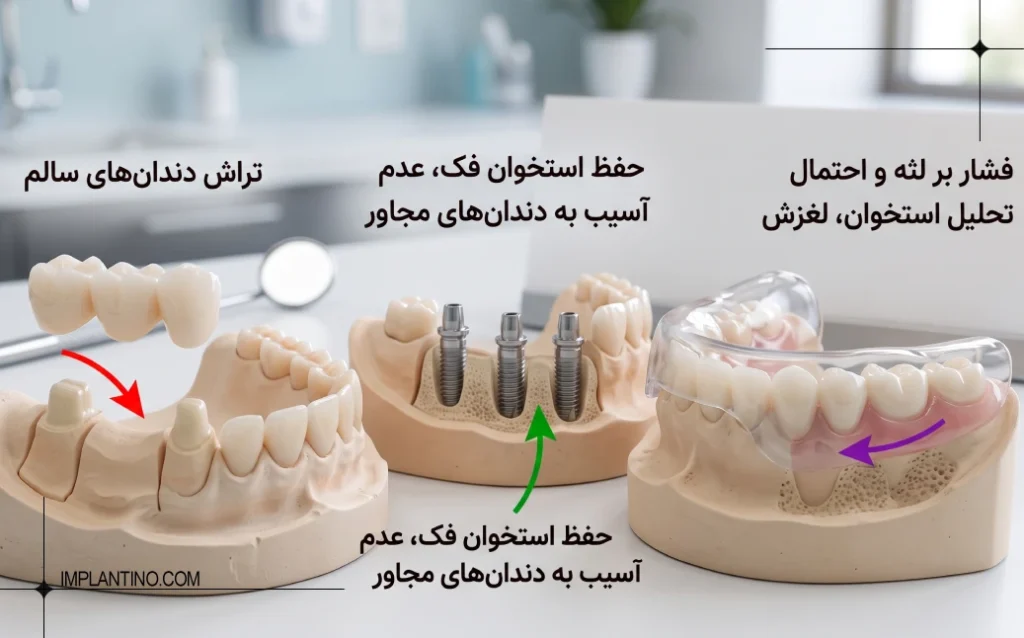 مقایسه ایمپلنت 0