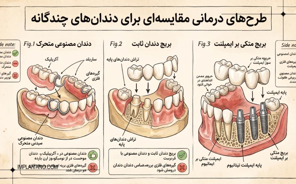 مقایسه ایمپلنت 4