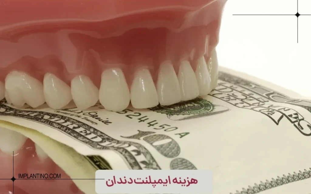 هزینه درمان All-on-4؛ از ایمپلنت تا پروتز نهایی 2 هزینه درمان All on 4 2